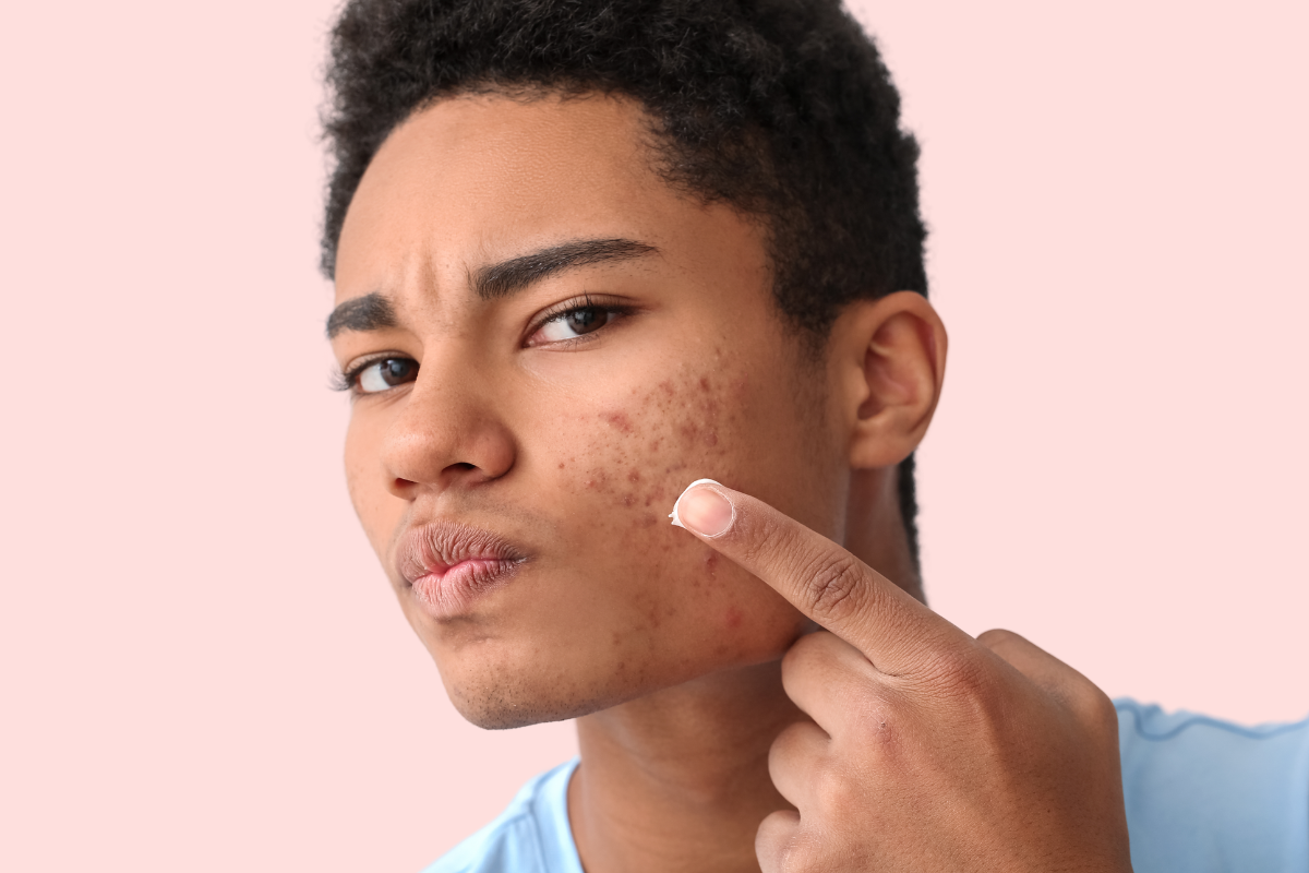 Breaking Out Again After Accutane? THIS May be Why and What to Do